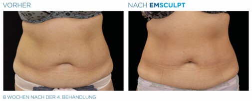 vorher nachher Fotos emsculpt Sixpack Muskelaufbau flacher Bauch bauchfettweg Muskeltraining dresden