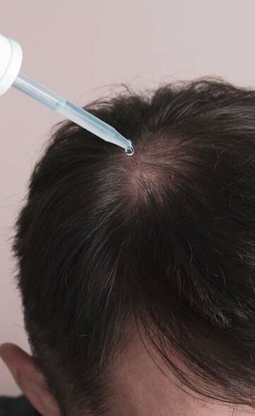 Haarausfall stoppen Haarwachstum Stimulieren Haartransplantation Eigenblut PRP Injektion Dresden