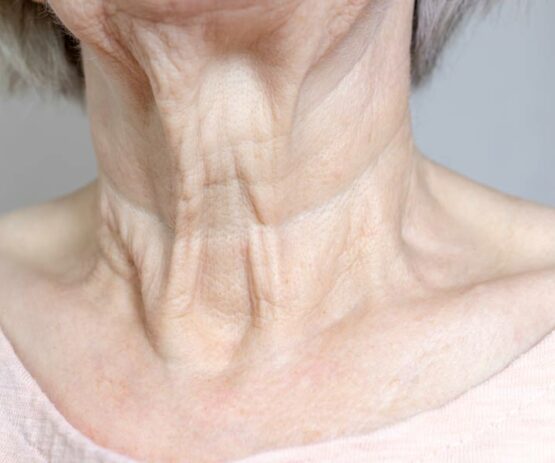 Hals Alter verjüngen Falten entfernen unterspritzen liften straffen