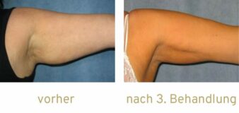 Fettwegspritze Injektionslipolyse lipolyse Fettabbau Kryolipolyse Arme Arm