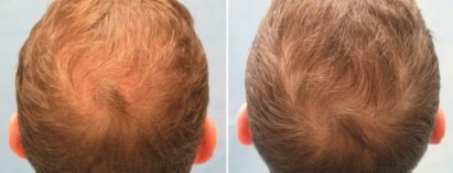 Triemer Aeshetics Dresden Mann Behandlung Haare Haarausfall Alopezie PRP Eigenblut Eigenplasma
