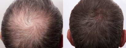 Triemer Aeshetics Dresden Mann Behandlung Haare Haarausfall Alopezie PRP Eigenblut Eigenplasma